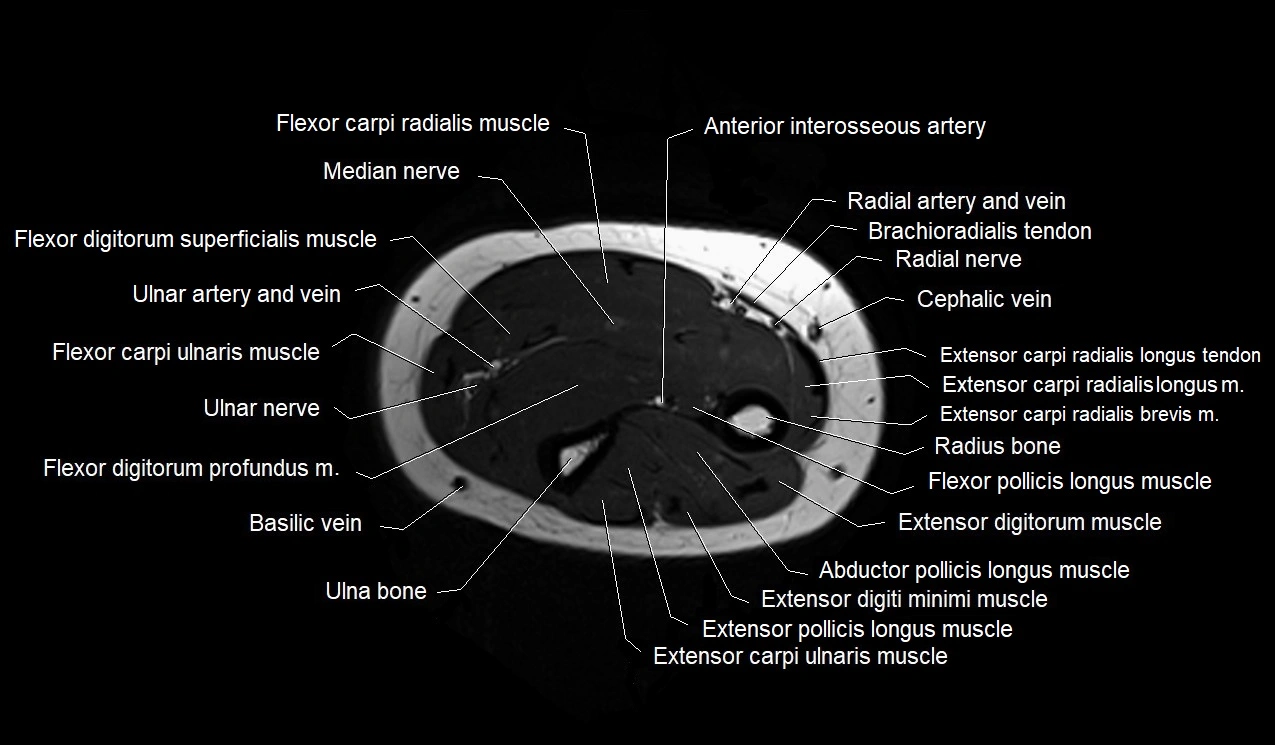 MRI 3T forearm axial cross sectional anatomy image 29.webp